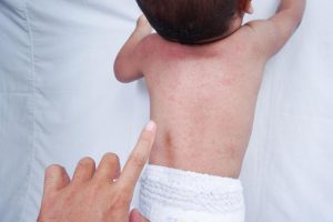 Alergia la căldură (miliaria): Cum recunoști iritația și ce măsuri să iei pentru a o preveni și trata