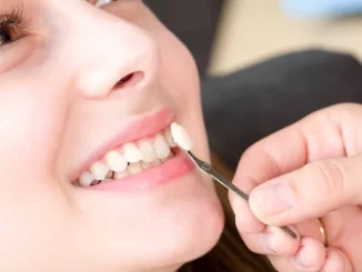 Cât rezistă fațetele dentare și de ce factori depinde durabilitatea lor