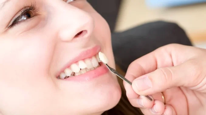 Cât rezistă fațetele dentare și de ce factori depinde durabilitatea lor Cât rezistă fațetele dentare și de ce factori depinde durabilitatea lor