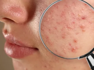 Acneea la adolescenţi: cum îţi linişteşti pielea cu ajutorul naturii