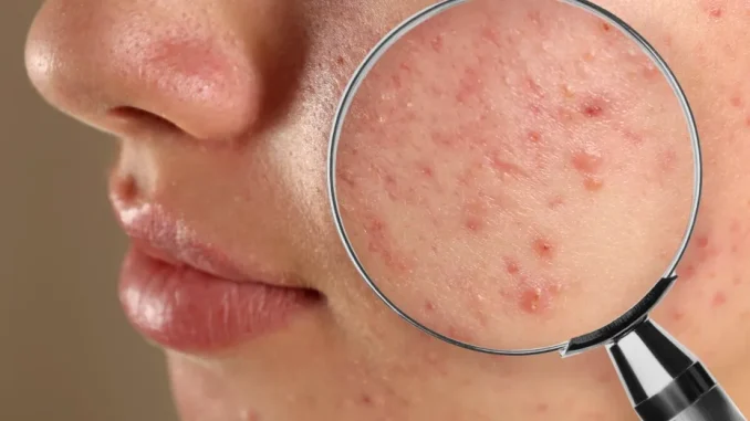 Acneea la adolescenţi: cum îţi linişteşti pielea cu ajutorul naturii