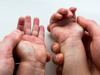 Dermatita atopică la copii – tot ce trebuie să știe părinții