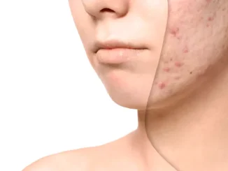 De ce se accentuează petele de pe ten în sezonul cald. Soluțiile naturale care pot reda luminozitatea pielii