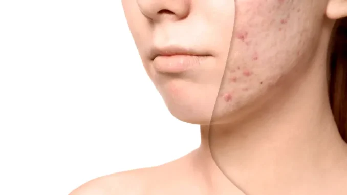 De ce se accentuează petele de pe ten în sezonul cald. Soluțiile naturale care pot reda luminozitatea pielii