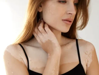 Vitiligo nu se transmite de la o persoană la alta. Ce spun dermatologii despre afecțiunea care continuă să fie înconjurată de prejudecăți